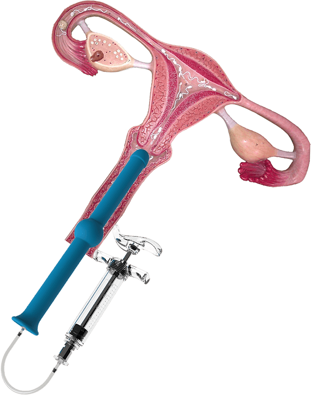 BabyMaker at-home insemination kit